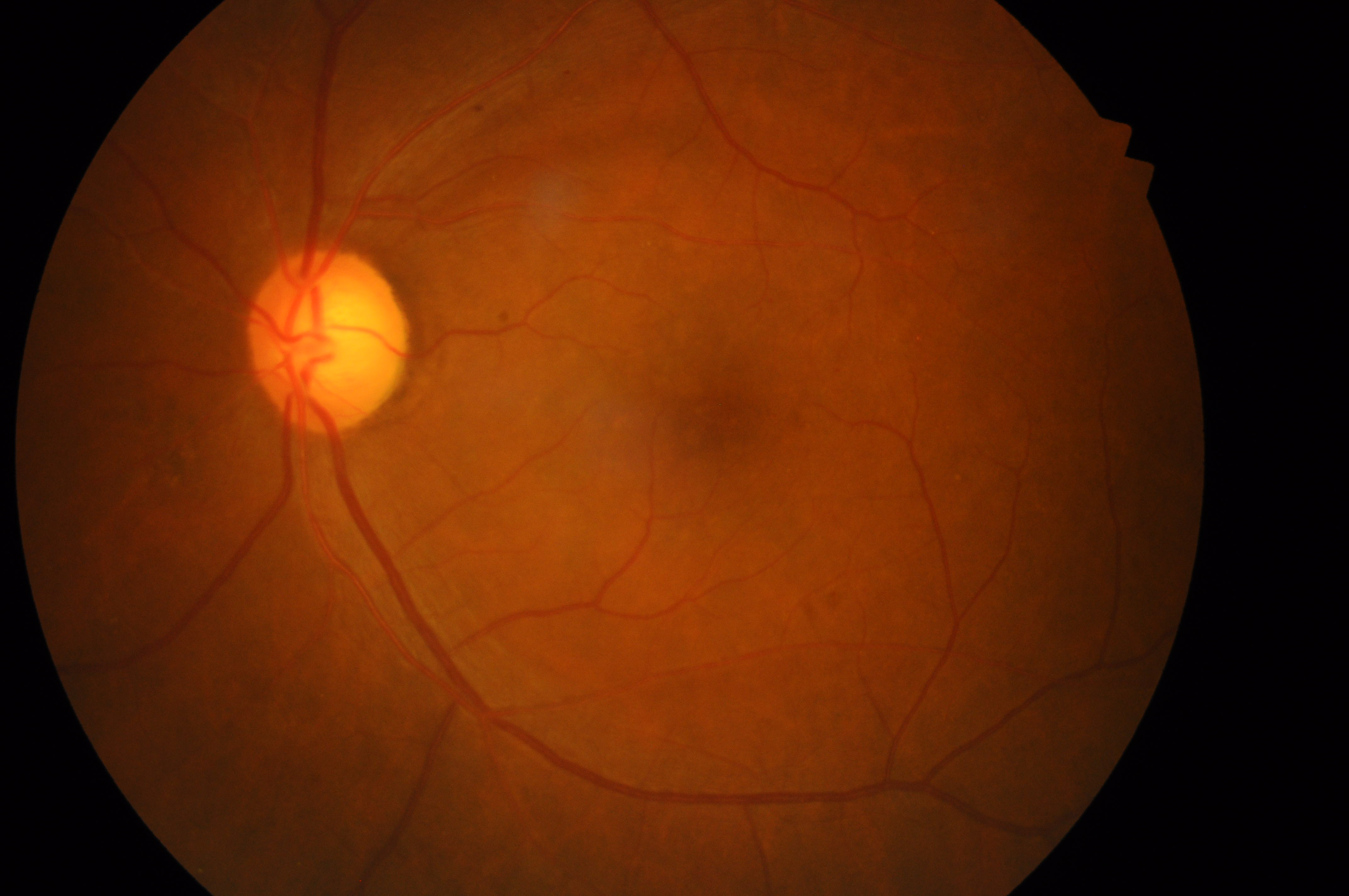 AI Glaucoma
